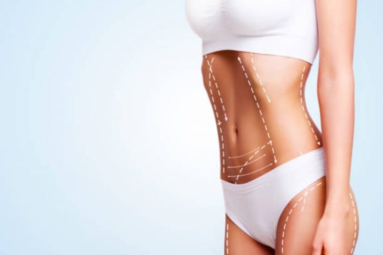 Consejos postoperatorios de una Lipoescultura